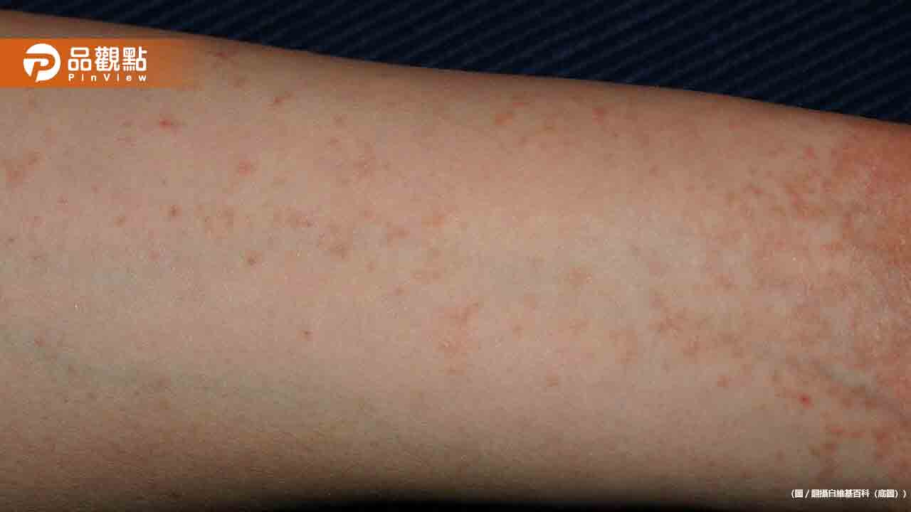 32歲女子全家「夜夜癢醒」醫師曝恐怖傳染真相